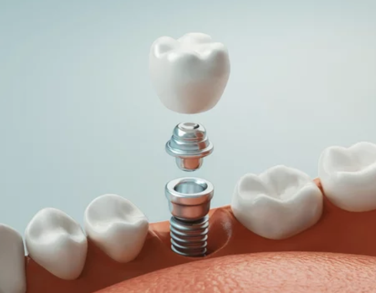 A 3D diagram of an dental implant